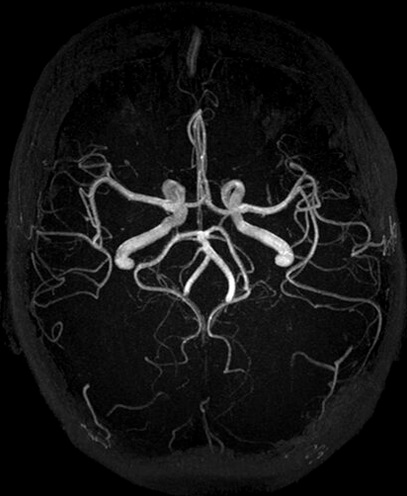 Time-of-flight MR angiogram of the circle of Willis